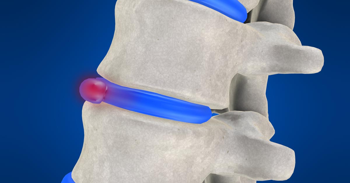 South Buffalo non-surgical disc herniation treatment