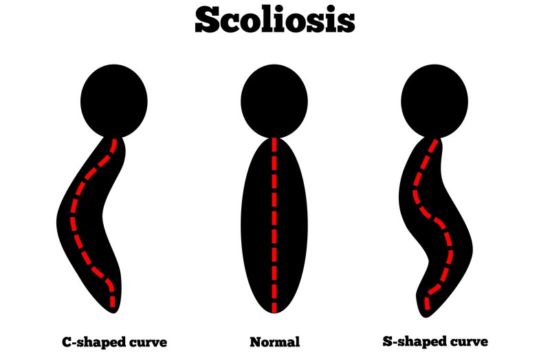 Buffalo, NY scoliosis treatment